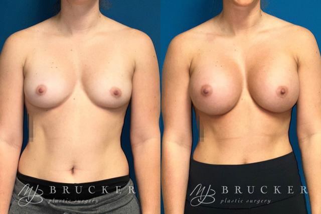 Fat Transfer Breast Augmentation result at Brucker Plastic Surgery in San Diego, CA