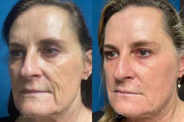 Microneedling result at Brucker Plastic Surgery in San Diego, CA