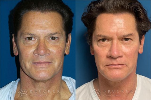 Laser Skin Resurfacing result at Brucker Plastic Surgery in San Diego, CA