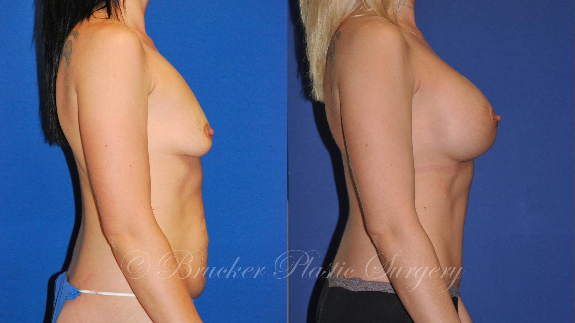 Brucker Plastic Surgery mommy makeover result — San Diego, CA