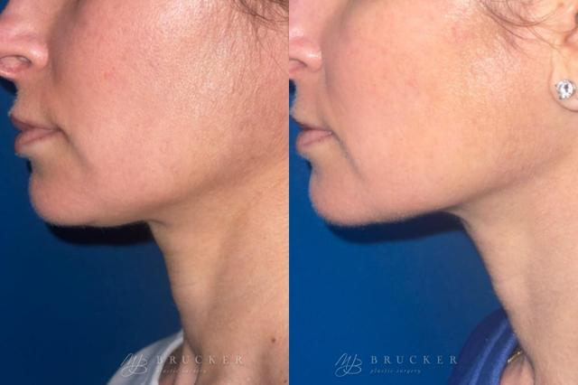Microneedling result at Brucker Plastic Surgery in San Diego, CA