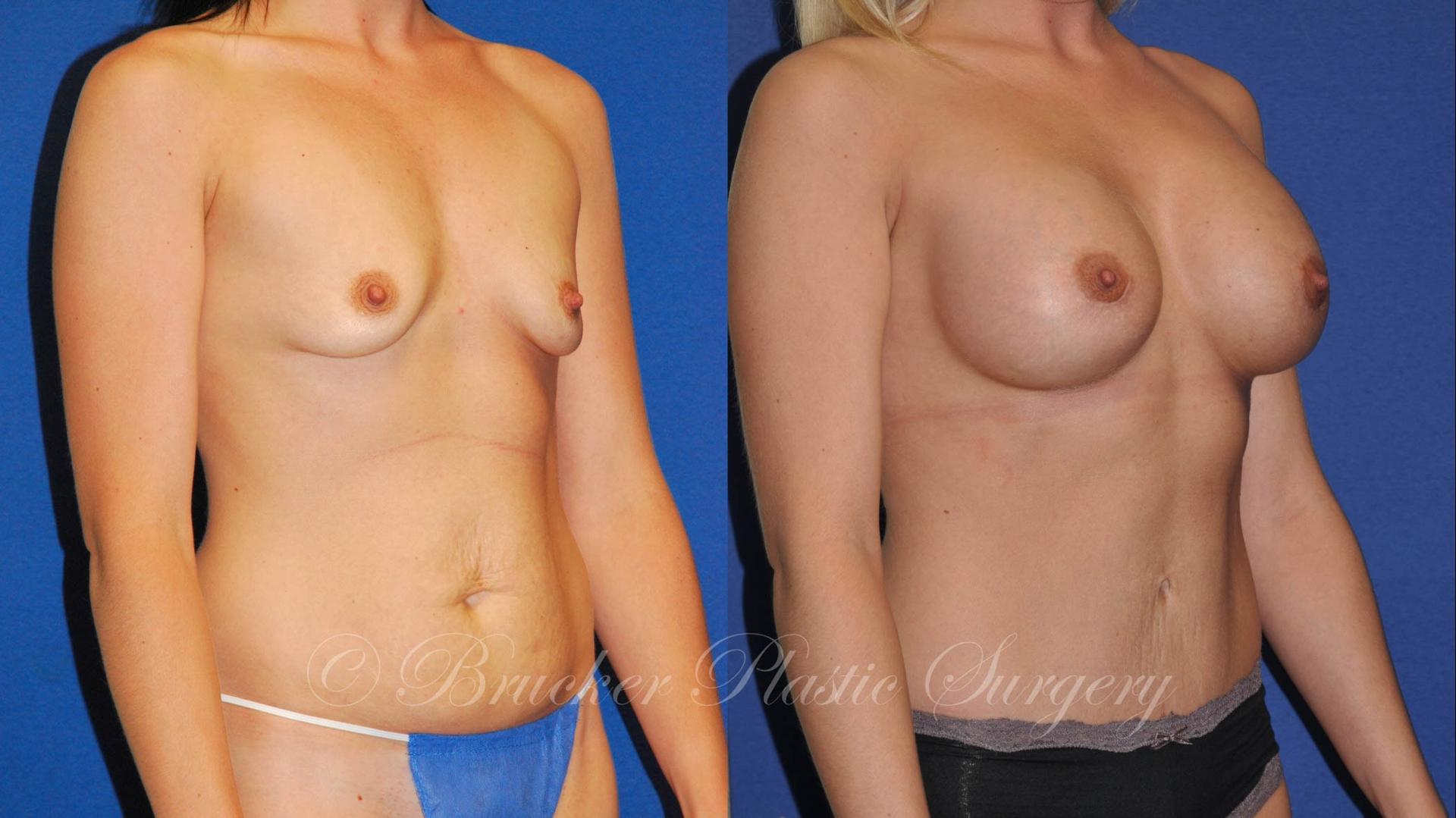Brucker Plastic Surgery mommy makeover result — San Diego, CA