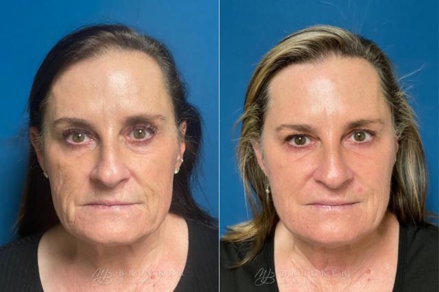 Microneedling result at Brucker Plastic Surgery in San Diego, CA