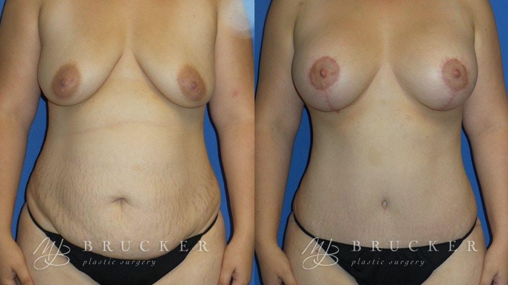 Brucker Plastic Surgery mommy makeover result — San Diego, CA