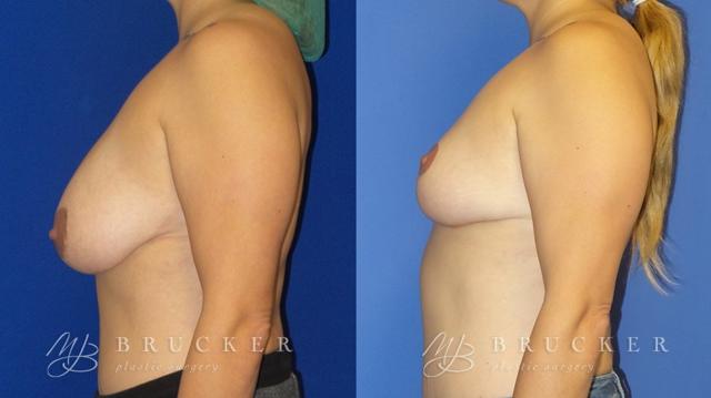 Breast Reduction result at Brucker Plastic Surgery in San Diego, CA