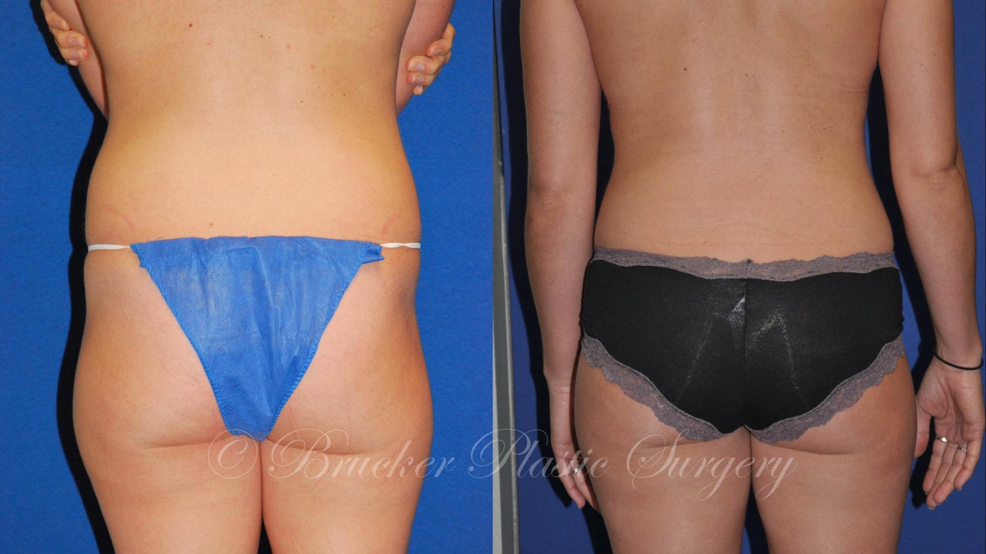Brucker Plastic Surgery mommy makeover result — San Diego, CA