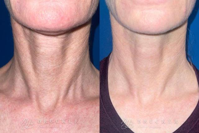 Microneedling result at Brucker Plastic Surgery in San Diego, CA