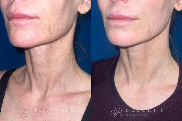 Microneedling result at Brucker Plastic Surgery in San Diego, CA