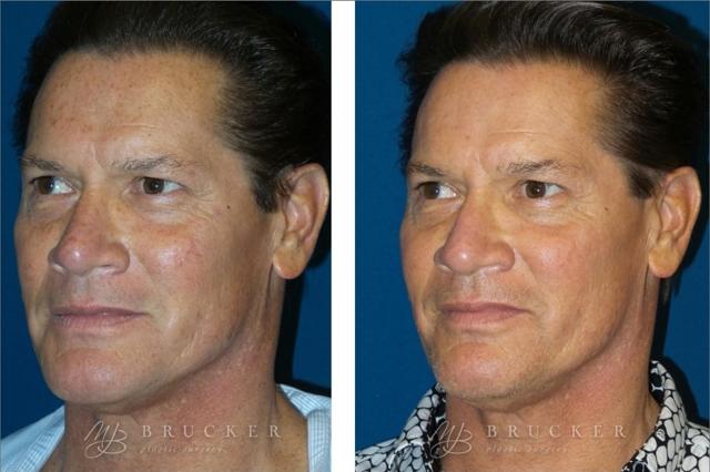 Laser Skin Resurfacing result at Brucker Plastic Surgery in San Diego, CA