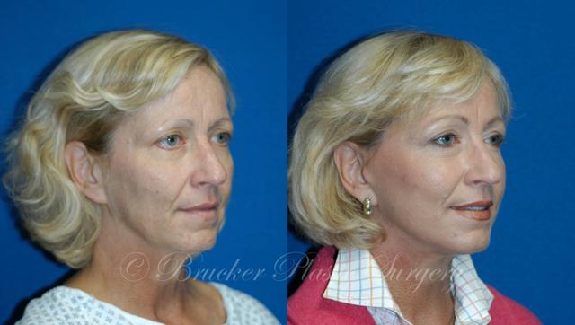 Facelift result at Brucker Plastic Surgery in San Diego, CA