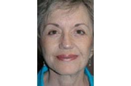 Advanced Aesthetic Surgery (Thomas B. Lintner, MD) facelift after — Marietta, GA