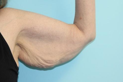 Arm Lift before at Advanced Aesthetic Surgery (Thomas B. Lintner, MD) in Marietta, GA