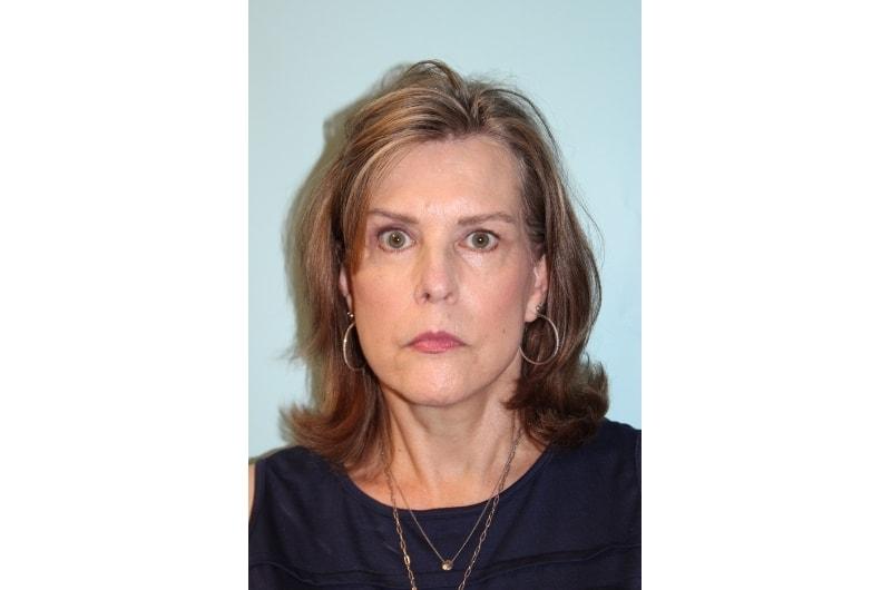 Advanced Aesthetic Surgery (Thomas B. Lintner, MD) facelift after — Marietta, GA