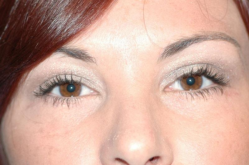 Advanced Aesthetic Surgery (Thomas B. Lintner, MD) eyelid lift after — Marietta, GA