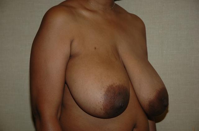 Breast Reduction before at Advanced Aesthetic Surgery (Thomas B. Lintner, MD) in Marietta, GA