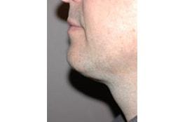 Advanced Aesthetic Surgery (Thomas B. Lintner, MD) neck liposuction after — Marietta, GA