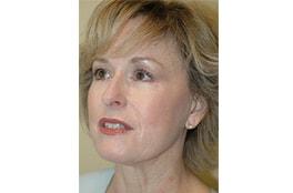 Advanced Aesthetic Surgery (Thomas B. Lintner, MD) brow lift after — Marietta, GA