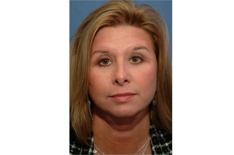 Advanced Aesthetic Surgery (Thomas B. Lintner, MD) facelift after — Marietta, GA