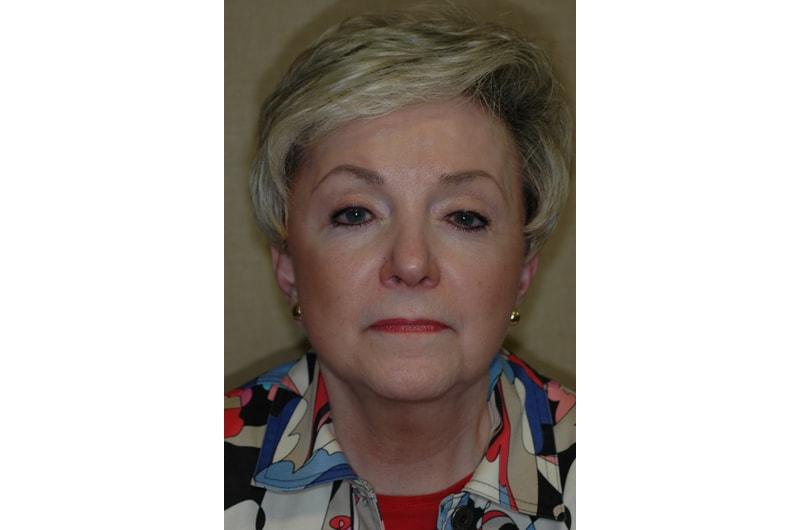 Advanced Aesthetic Surgery (Thomas B. Lintner, MD) facelift after — Marietta, GA