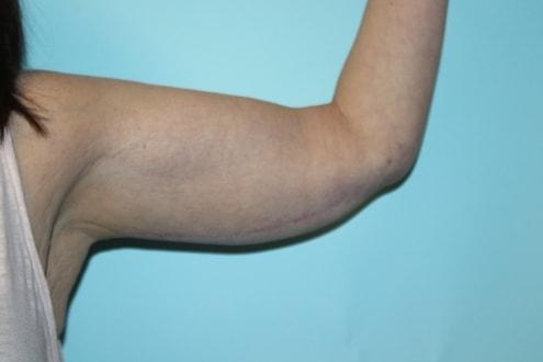 Arm Lift after at Advanced Aesthetic Surgery (Thomas B. Lintner, MD) in Marietta, GA