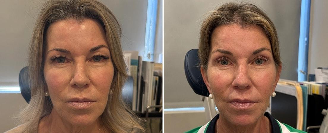 Alexander Rabinovich, MD eyelid lift result — Brooklyn, NY