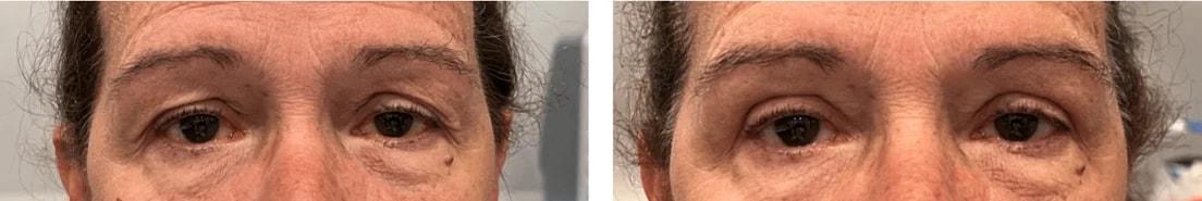 Alexander Rabinovich, MD eyelid lift result — Brooklyn, NY
