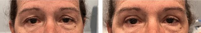 Blepharoplasty result at Alexander Rabinovich, MD in Brooklyn, NY