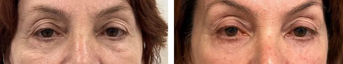 Alexander Rabinovich, MD eyelid lift result — Brooklyn, NY