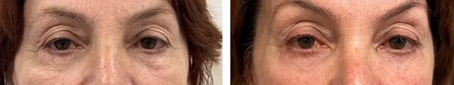 Blepharoplasty result at Alexander Rabinovich, MD in Brooklyn, NY