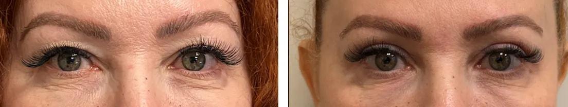 Alexander Rabinovich, MD eyelid lift result — Brooklyn, NY