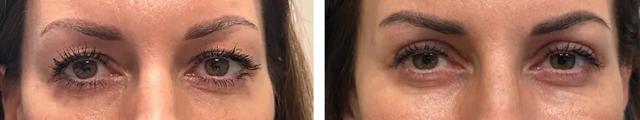 Blepharoplasty result at Alexander Rabinovich, MD in Brooklyn, NY