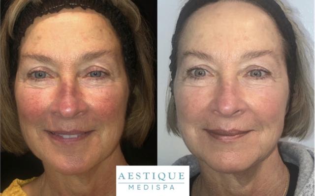 Brazilian Butt Lift result at Aestique Medispa in Pittsburgh, PA