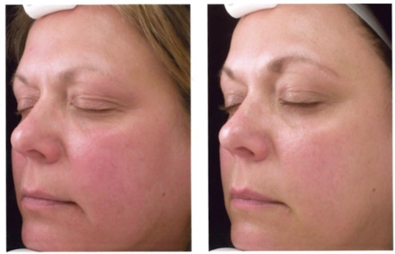 Aestique Medispa photofacial result — Pittsburgh, PA