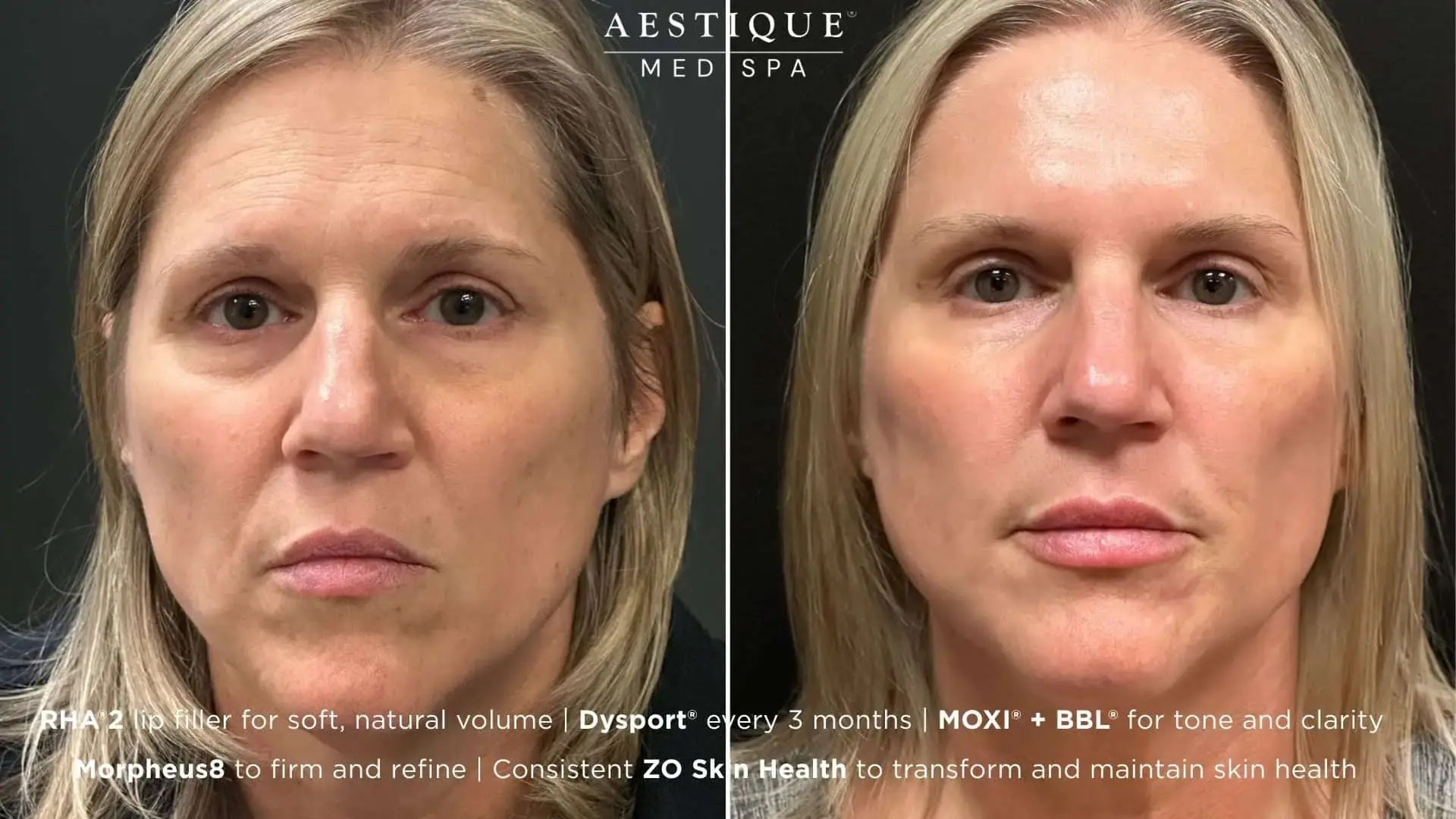 Aestique Medispa result — Pittsburgh, PA