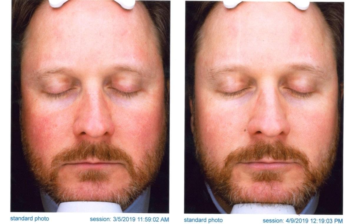 Aestique Medispa photofacial result — Pittsburgh, PA