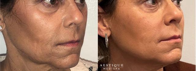 Microneedling result at Aestique Medispa in Pittsburgh, PA