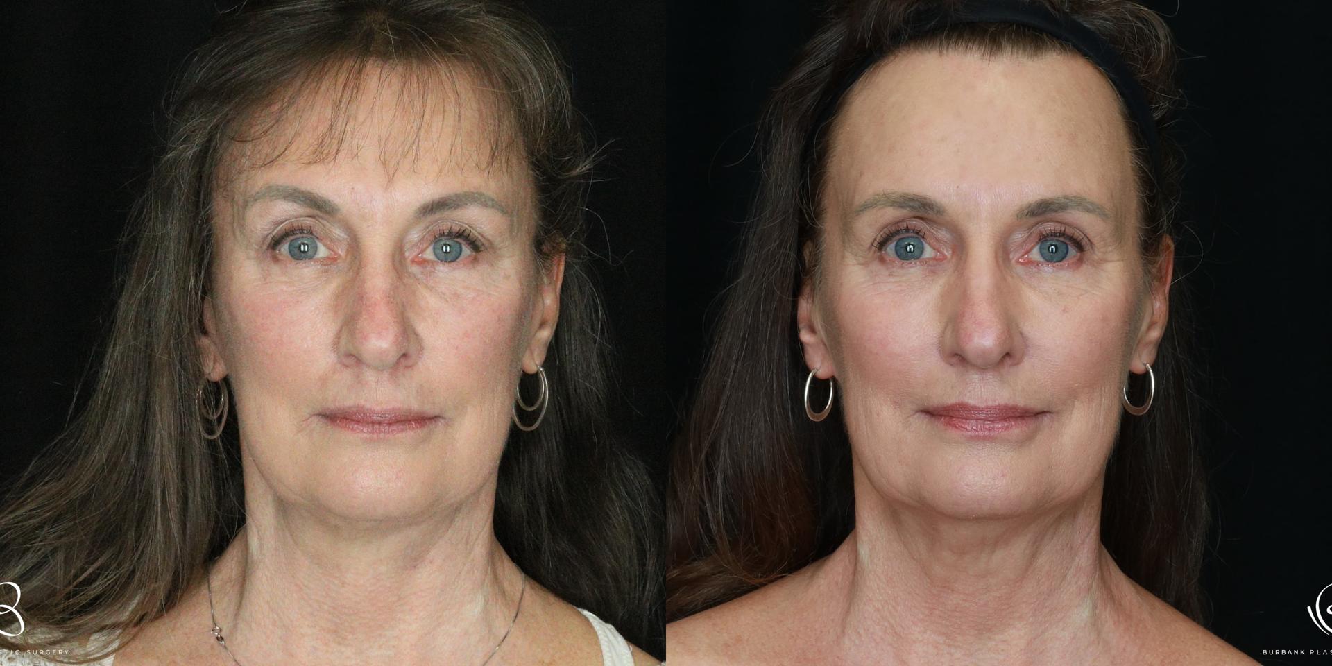 Burbank Plastic Surgery facelift result — Burbank, CA