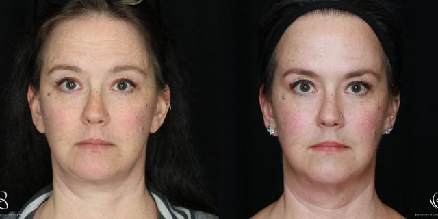 Deep Plane Facelift result at Burbank Plastic Surgery in Burbank, CA