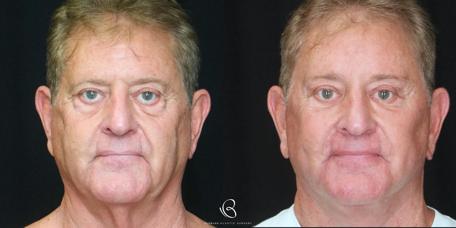 Burbank Plastic Surgery facelift result — Burbank, CA
