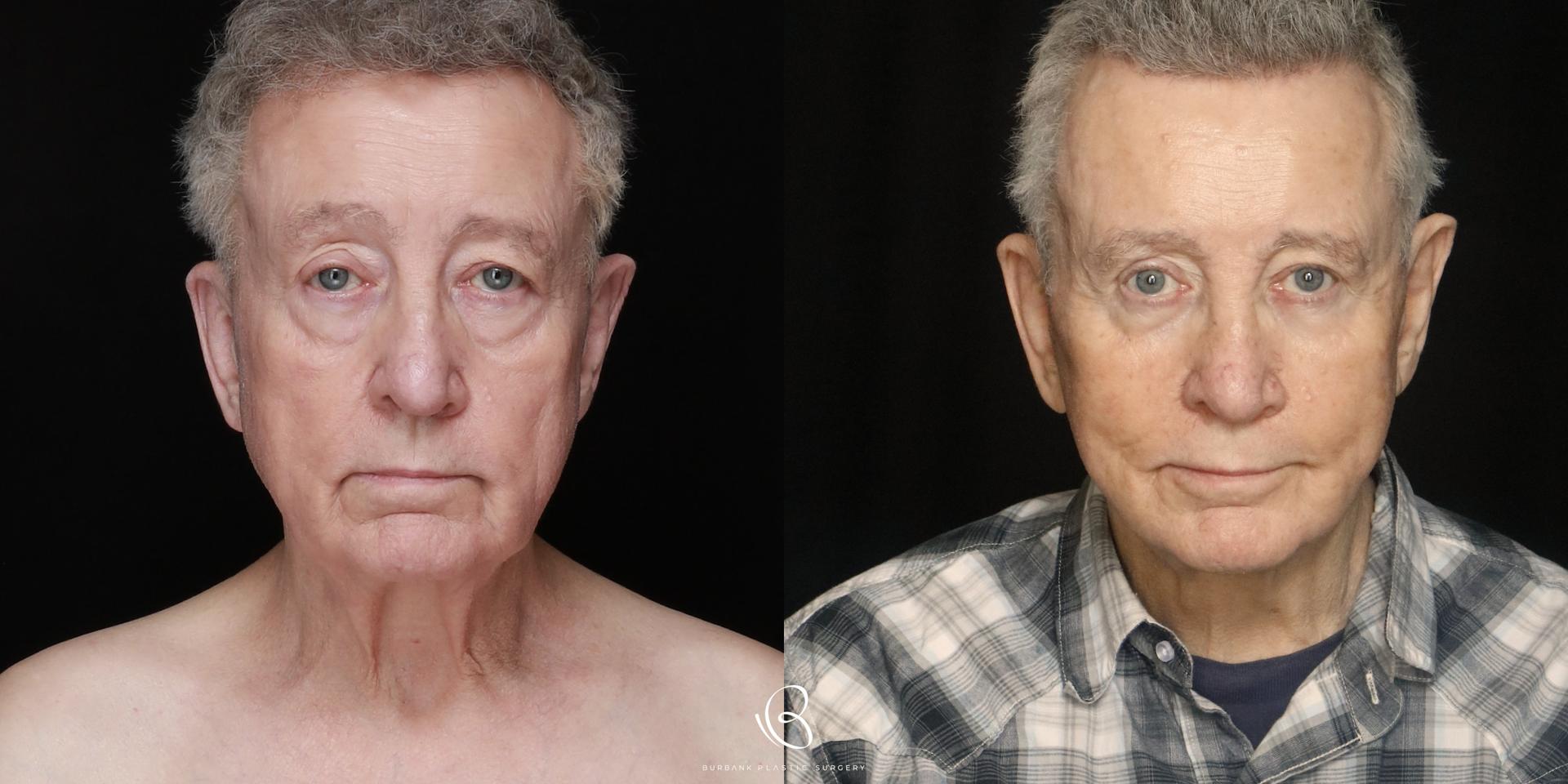 Burbank Plastic Surgery facelift result — Burbank, CA