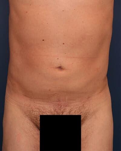 Thigh Lift after at Ronald H. Schuster, MD in Timonium, MD
