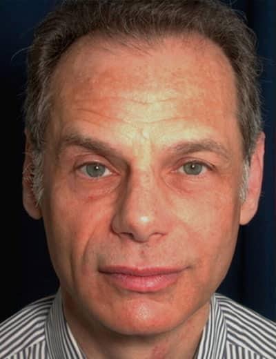 Functional Rhinoplasty after at Ronald H. Schuster, MD in Timonium, MD