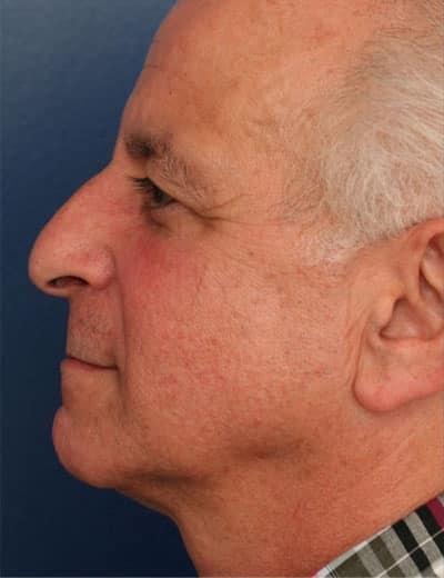 Rhinoplasty before at Ronald H. Schuster, MD in Timonium, MD