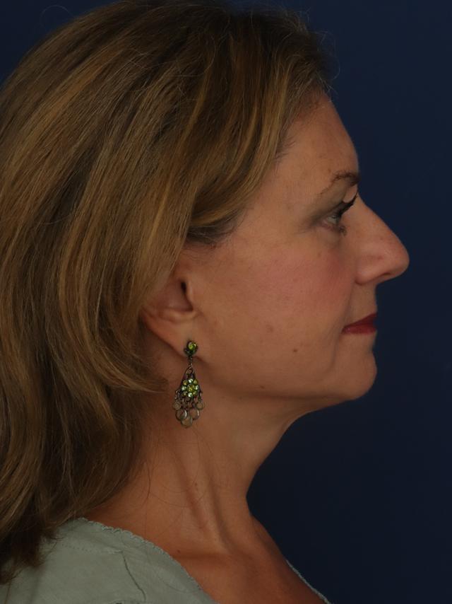 Facelift after at Ronald H. Schuster, MD in Timonium, MD