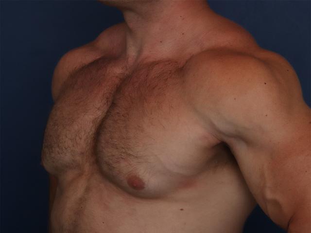 Gynecomastia Surgery before at Ronald H. Schuster, MD in Timonium, MD