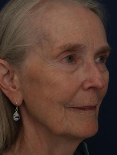 Laser Skin Resurfacing before at Ronald H. Schuster, MD in Timonium, MD