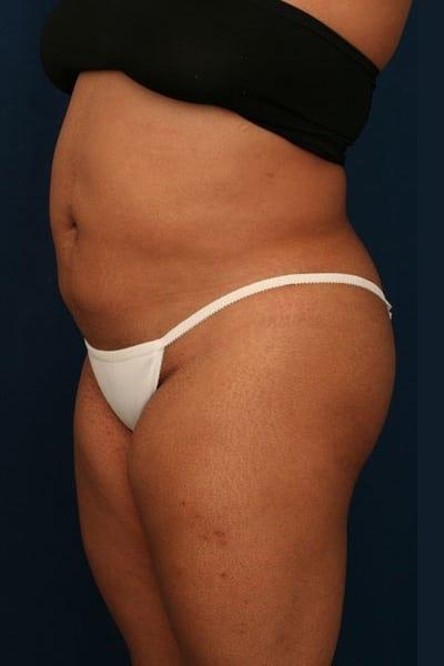 Brazilian Butt Lift after at Ronald H. Schuster, MD in Timonium, MD