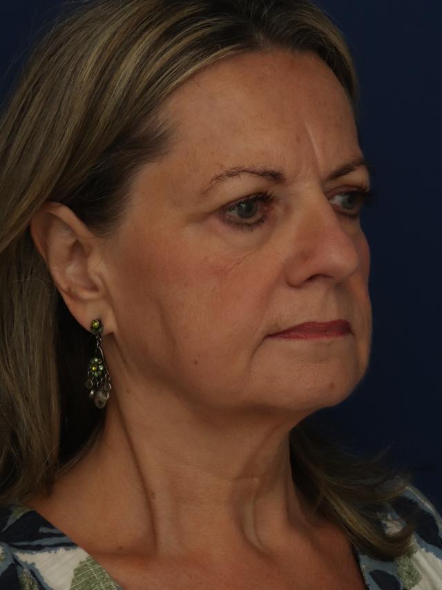 Facelift before at Ronald H. Schuster, MD in Timonium, MD