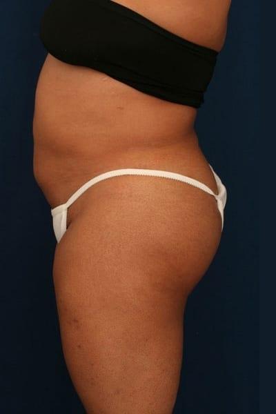 Brazilian Butt Lift after at Ronald H. Schuster, MD in Timonium, MD