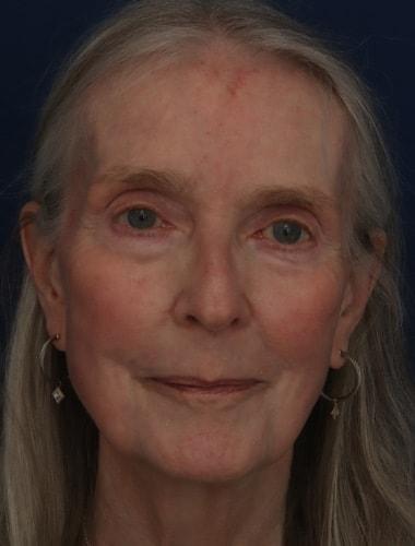 Laser Skin Resurfacing after at Ronald H. Schuster, MD in Timonium, MD